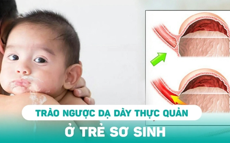 Trào ngược dạ dày thực quản gây khò khè và nôn trớ ở trẻ
