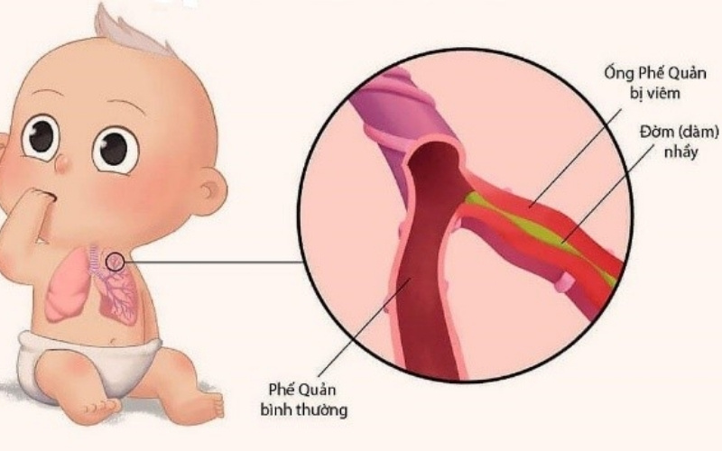 Mẹo tự nhiên giúp giảm triệu chứng khò khè cho trẻ sơ sinh
